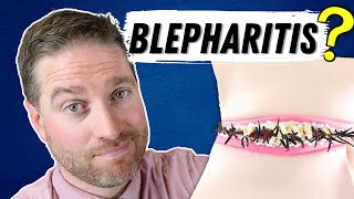 What Is Blepharitis Blepharitis Explained  Best Treatments [upl. by Coriss]