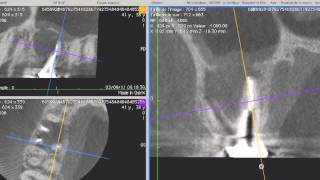 Apport du laser ErbiumYag en endodontie chirurgicale Dr David Bensoussan  Vidéo 1 [upl. by Ziom312]