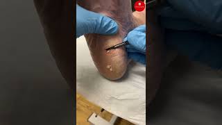 Callus Removal [upl. by Paymar]