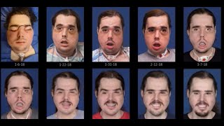 See the remarkable recovery progression of face transplant patient Cameron Underwood of Yuba City [upl. by Laddy]