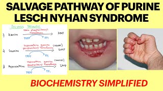 Salvage pathway of purines  Lesch nyhan syndrome  Purine metabolism  Biochemistry 1st yr MBBS [upl. by Anillek]