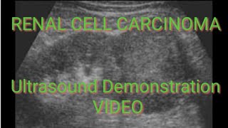 RENAL CELL CARCINOMA on Ultrasound Video Demonstration [upl. by Raasch]