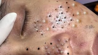 Big Cystic Acne Blackheads Extraction Blackheads amp Milia Whiteheads Removal Pimple Popping  2498 [upl. by Samoht]