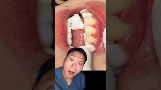 Removing Composite Veneers 😭 veneers composite smiletransformation compositeveneers [upl. by Casar]