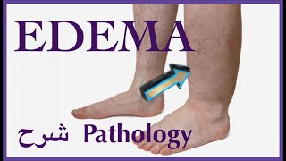 Pathology  Edema 1  introduction   👨🏻‍⚕️ شرح باثو [upl. by Essirehc]