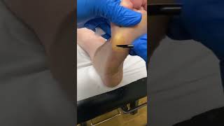 Expert Australian Podiatrist Removes Thick Callus from Forefoot with Precision [upl. by Normak870]