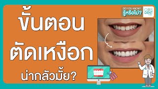 เลเซอร์ ตัด เหงือก มีขั้นตอนอย่างไร  คุณหมอฝากมา Ep38 COSDENT SMILE DESIGN [upl. by Eamanna]