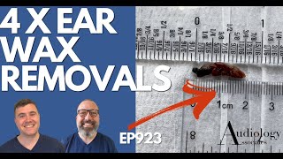 4 x EAR WAX REMOVALS INC BIG EAR WAX PLUG  EP923 [upl. by Caniff]