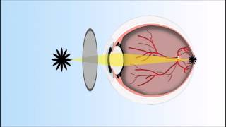 Presbyopia Explained Annimated Video [upl. by Oiragelo]