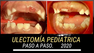 ULECTOMÍA PEDIÁTRICA PASO A PASO 2020 [upl. by Finlay]