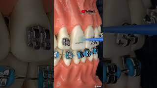 TUTORIAL “INSTALACIÓN de BRACKETS metálicos” [upl. by Warchaw155]