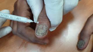 Demo18 Intramatrix injection of triamcinolone for nail disorders [upl. by Bronnie]