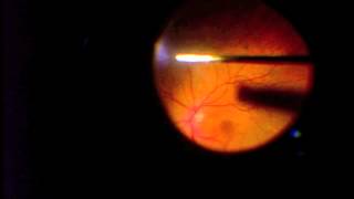 Vitrectomy for Vitreous Opacification FOV [upl. by Ahseila]