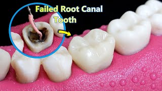 INCREDIBLE Reconstruction Of PoorFailed Root Canal Treated Tooth [upl. by Aphrodite]