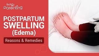 What Causes Swelling in the Legs Ankles amp Feet Edema How Can You Treat Swelling Doctor Explains [upl. by Christalle477]