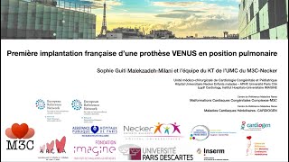 Première implantation française dune prothèse VENUS en position pulmonaire [upl. by Arteid]