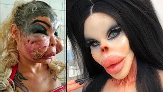 When Plastic Surgery Goes Horribly Wrong [upl. by Idel769]