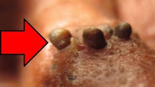 Nose Blackheads Chin Blackheads amp Pimple Pops [upl. by Airamesor]