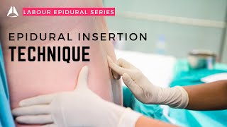 The Epidural Insertion  anesthesiology anesthesia analgesia epidural [upl. by Ynnig]