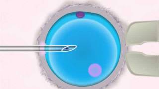 Icsi IVF  Intracytoplasmic Sperm Injection [upl. by Ecreip]