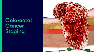 Colorectal Cancer Staging [upl. by Yelik]