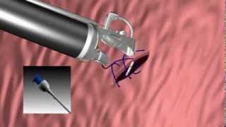 OverStitch™ Animation  Suturing Sequence [upl. by Afra288]