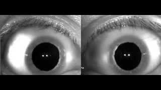 Patient with dehiscent Anterior Semicircular Canal ASCC performing Valsalva maneuvers [upl. by Ojoj441]