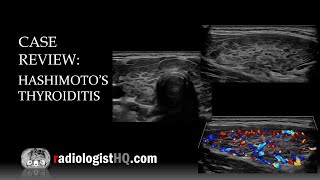 Ultrasound of Hashimoto’s Thyroiditis [upl. by Uel]