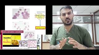 G6PD deficiency انیمیا الفول [upl. by Stinson]