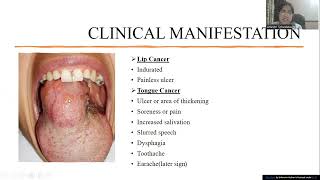 Cancer of the Oral Cavity [upl. by Oigimer]