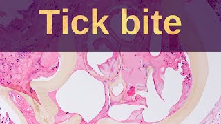 Tick Bites  Pathology mini tutorial [upl. by Neelrac]