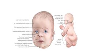 DiGeorge Syndrome ppt [upl. by Bartley]