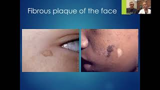 Dermatologic considerations in Tuberous Sclerosis Complex by Dr Grevelink and Dr Siegel [upl. by De]