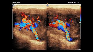 Pleomorphic Adenoma of Parotid Gland  Ultrasound  Doppler  Case 05 [upl. by Hahsi349]