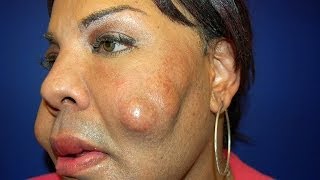 Cosmetic Surgery Disaster Woman Dubbed Cement Face Given New Lease Of Life [upl. by Ayeki223]