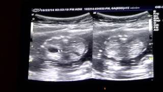 Ultrasound Anatomy Scan  19 Weeks Pregnant [upl. by Prochora890]