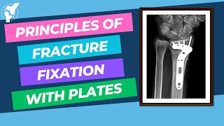 Principles of Fracture Internal Fixation With Plates and Screws  Material Properties [upl. by Anyak111]