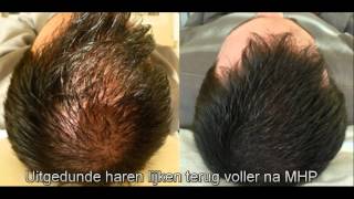 Micro haar pigmentatie belgie nederland [upl. by Kylander]