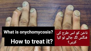 Onychomycosis  Nail Fungal Infection and Treatment [upl. by Jade]