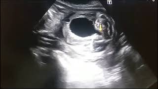 Posterior urethral valve obstacle ultrasound do watch and subscribe us [upl. by Thanos]