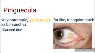 Pinguecula  Pterygium  short notes and differential diagnosis  Conjunctiva [upl. by Zacharie]