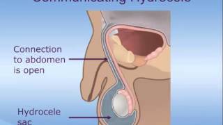 Hydrocele Repair In Children [upl. by Ecnerual]