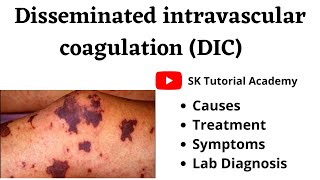 Disseminated intravascular coagulation  DIC syndrome [upl. by Chansoo]