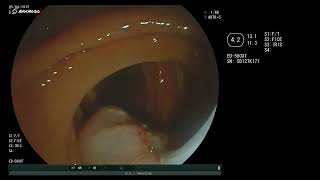 papillary ampulloma [upl. by Ahsinra]