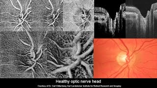 Swept Source 3D OCT Angiography [upl. by Uohk]