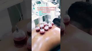 CUPPING HIJAMA THERAPY RAICHUR cupping hijama viral shorts [upl. by Yrellam]