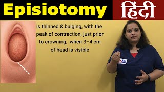 Episiotomy in Hindi  Perineotomy  Nursing Lecture [upl. by Elvie]