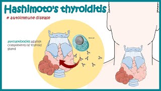 Hashimotos thyroiditis  Autoimmune diseases [upl. by Idnic]