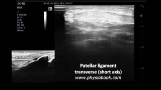 Osgood–Schlatter disease  MSK Ultrasond [upl. by Mcculloch914]