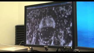 Prostate Biopsy Targeted Biopsy Using MRUltrasound Fusion [upl. by Anomas970]